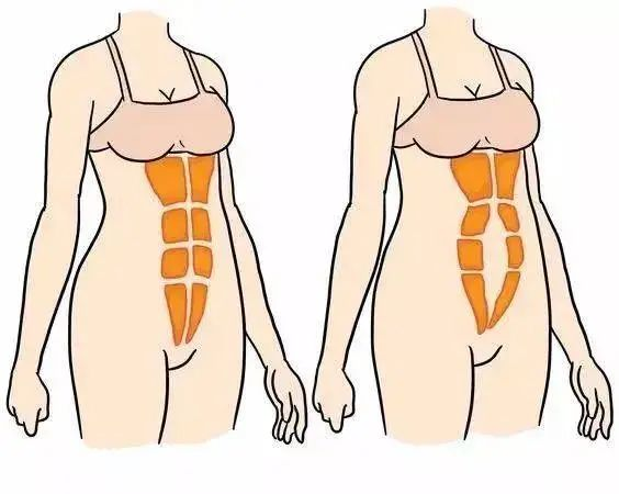 你的腹直肌分离了吗？一步就知道