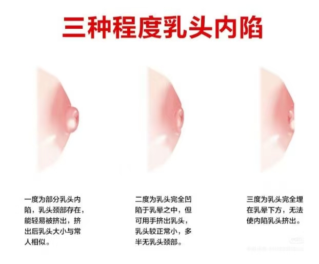 乳头凹陷的妈妈该如何哺乳？