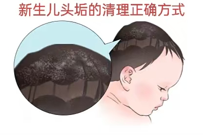 新生儿头垢的正确清理方式